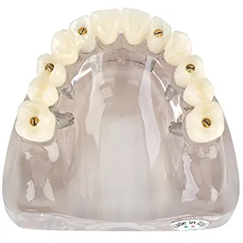 Practicon 4112161 Screw-Retained Full Arch Implant Model