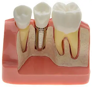 AZDENT® Dental Model Implant Analysis Crown Bridge Demonstration Teeth Model for Education